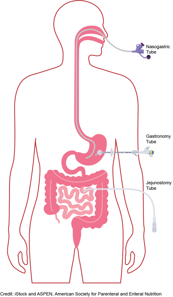 Various types of feeding tubes on a patient